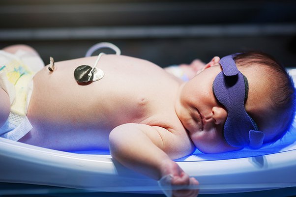 Effective Methods to Manage Newborn Baby Jaundice